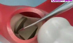 拔智齿视频全真实过程,拔智齿的真实手术过程